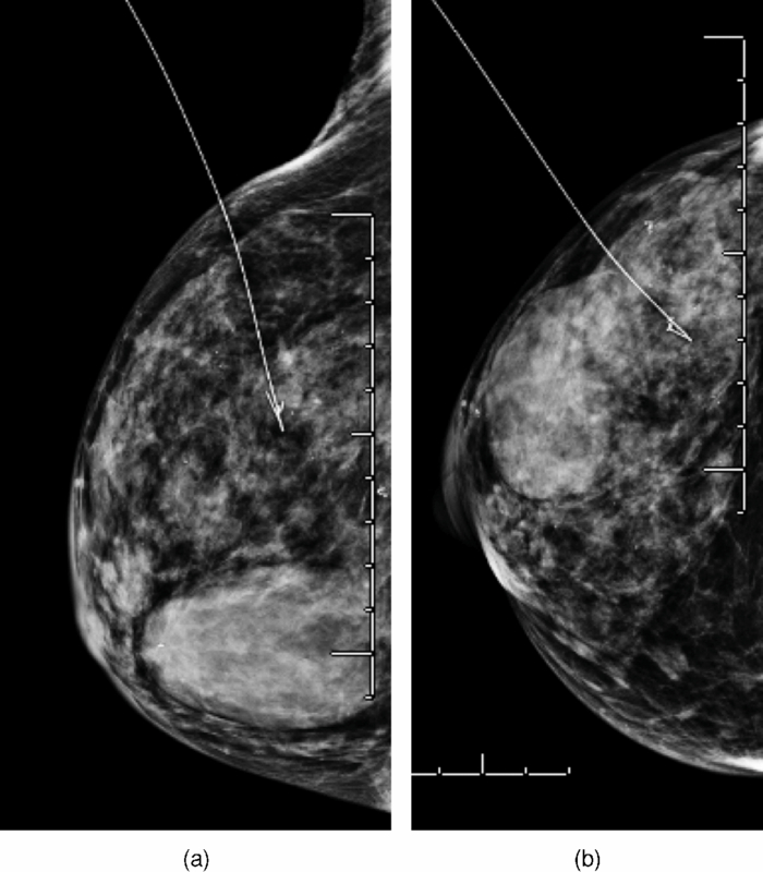 Lightguided lumpectomy device and case report