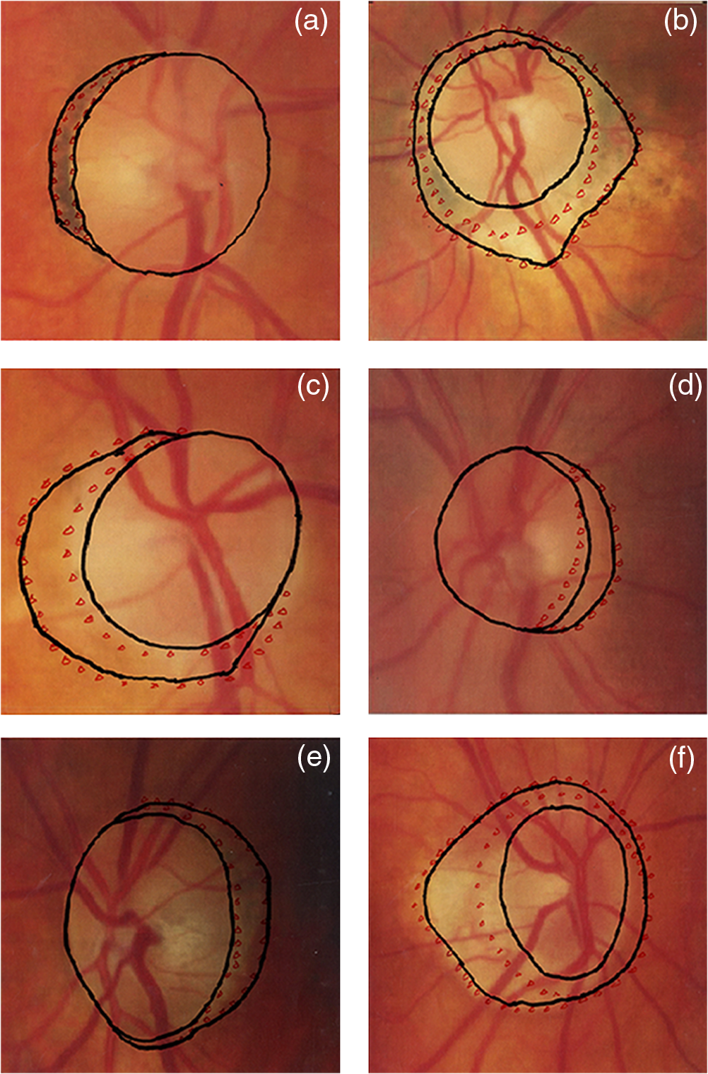 Parapapillary atrophy and optic disc region assessment (PANDORA): retinal  imaging tool for assessment of the optic disc and parapapillary atrophy