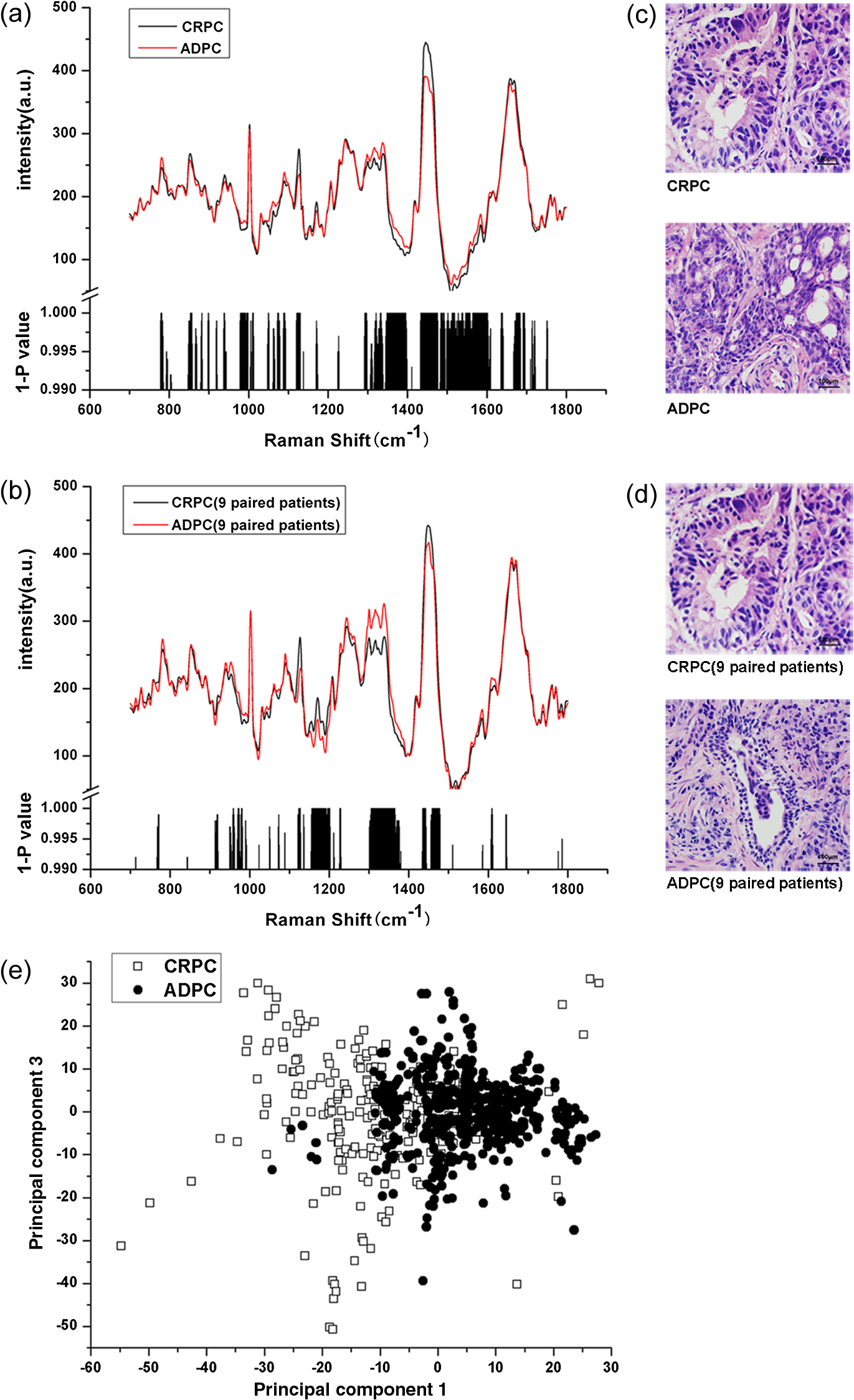 Raman spectroscopy, a potential tool in diagnosis and prognosis of ...