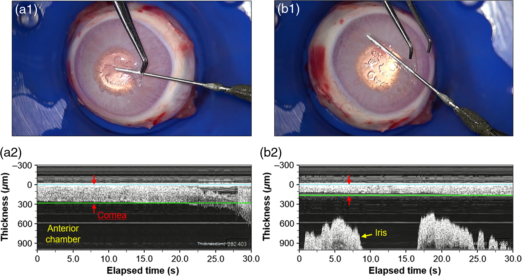 Lamellar Keratoplasty Using Position Guided Surgical Needle - 