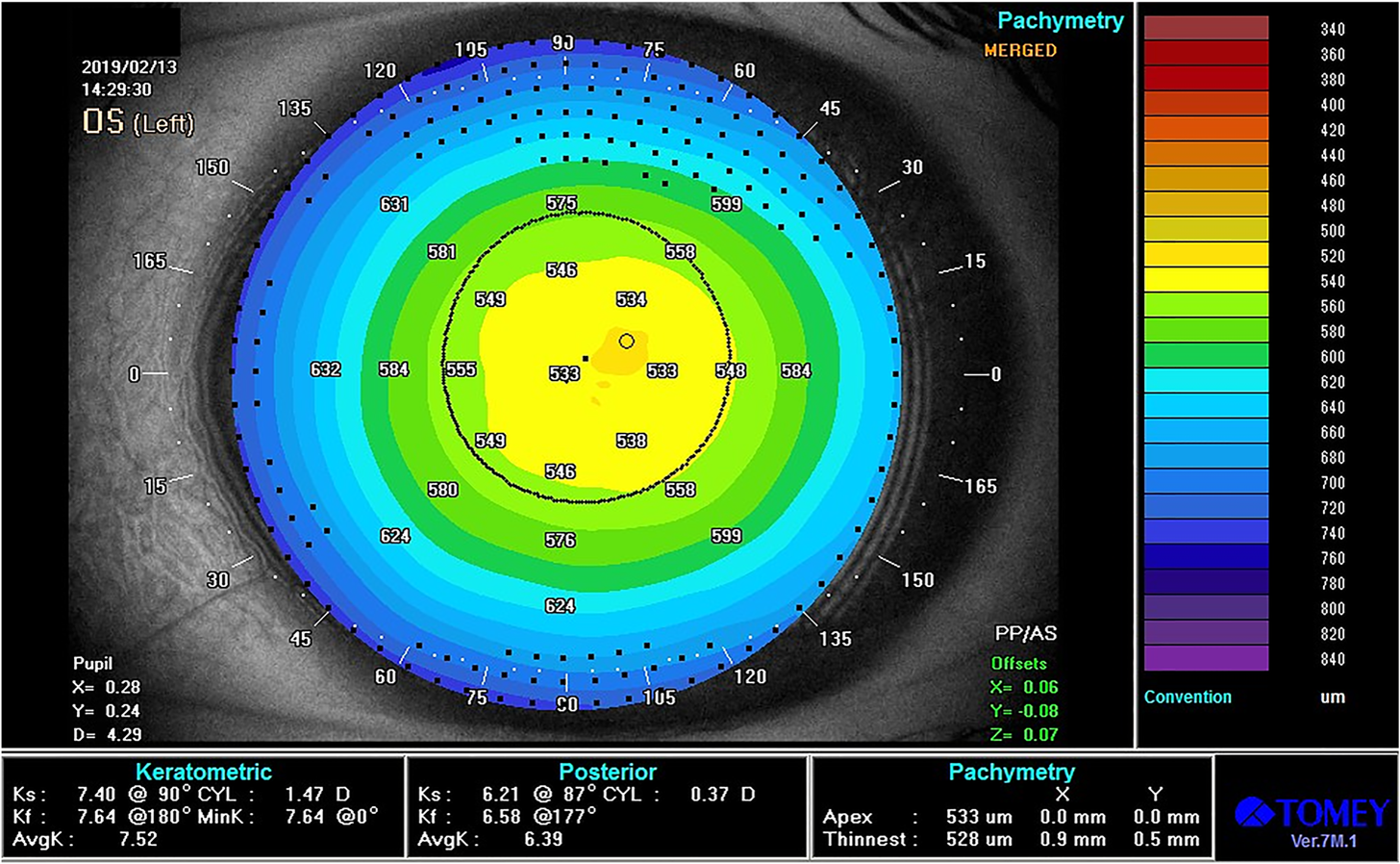 Beskonačnost Izuzetan broj pachymetry conversion chart terorizam