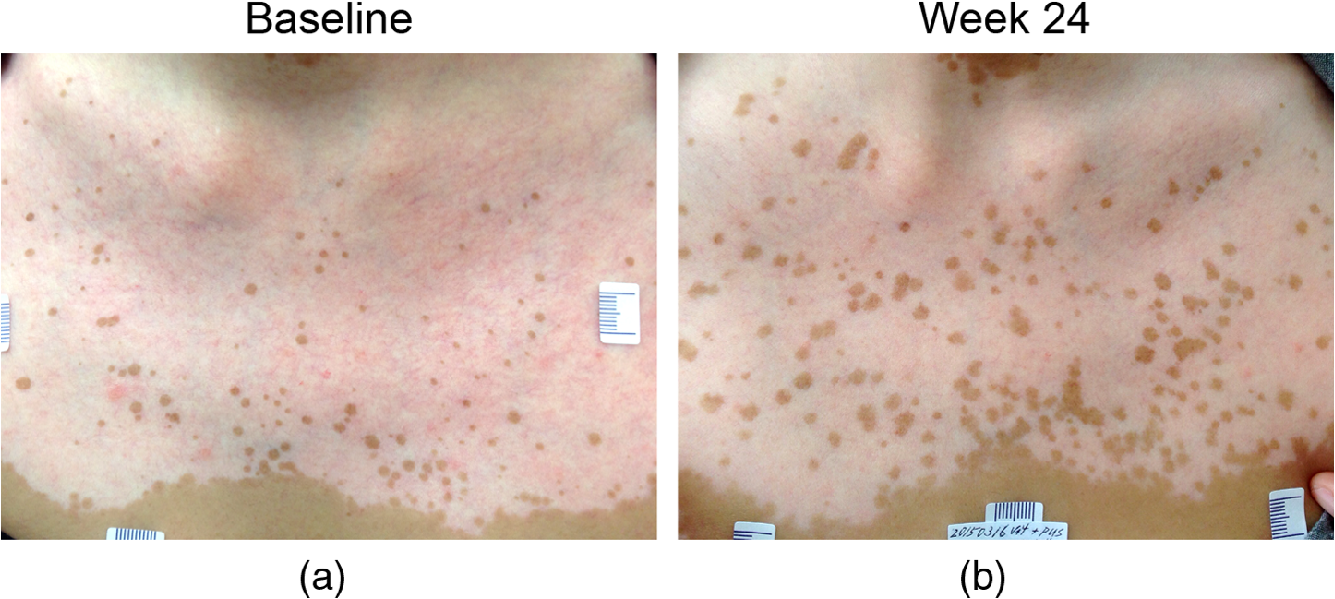 In vivo third-harmonic generation microscopy study on vitiligo patients
