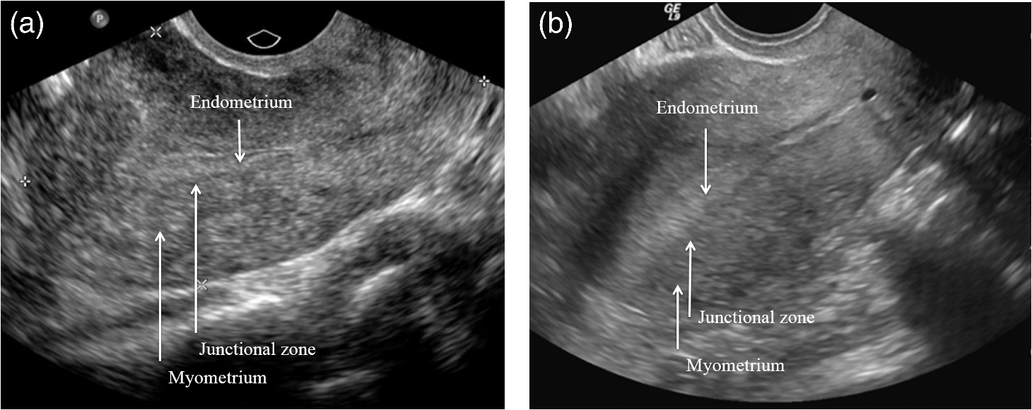 Quantitative Analysis Of Ultrasound Images For Computer Aided Diagnosis Quantitative Analysis Of Ultrasound Images For Computer Aided Diagnosis