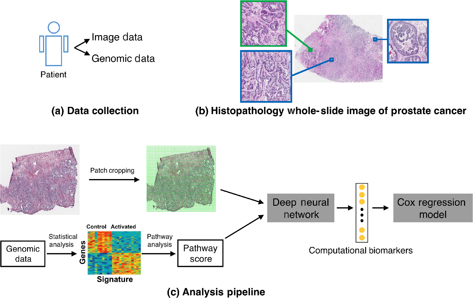 adenocarcinoma de próstata gleason 3 3 puntaje 6 5