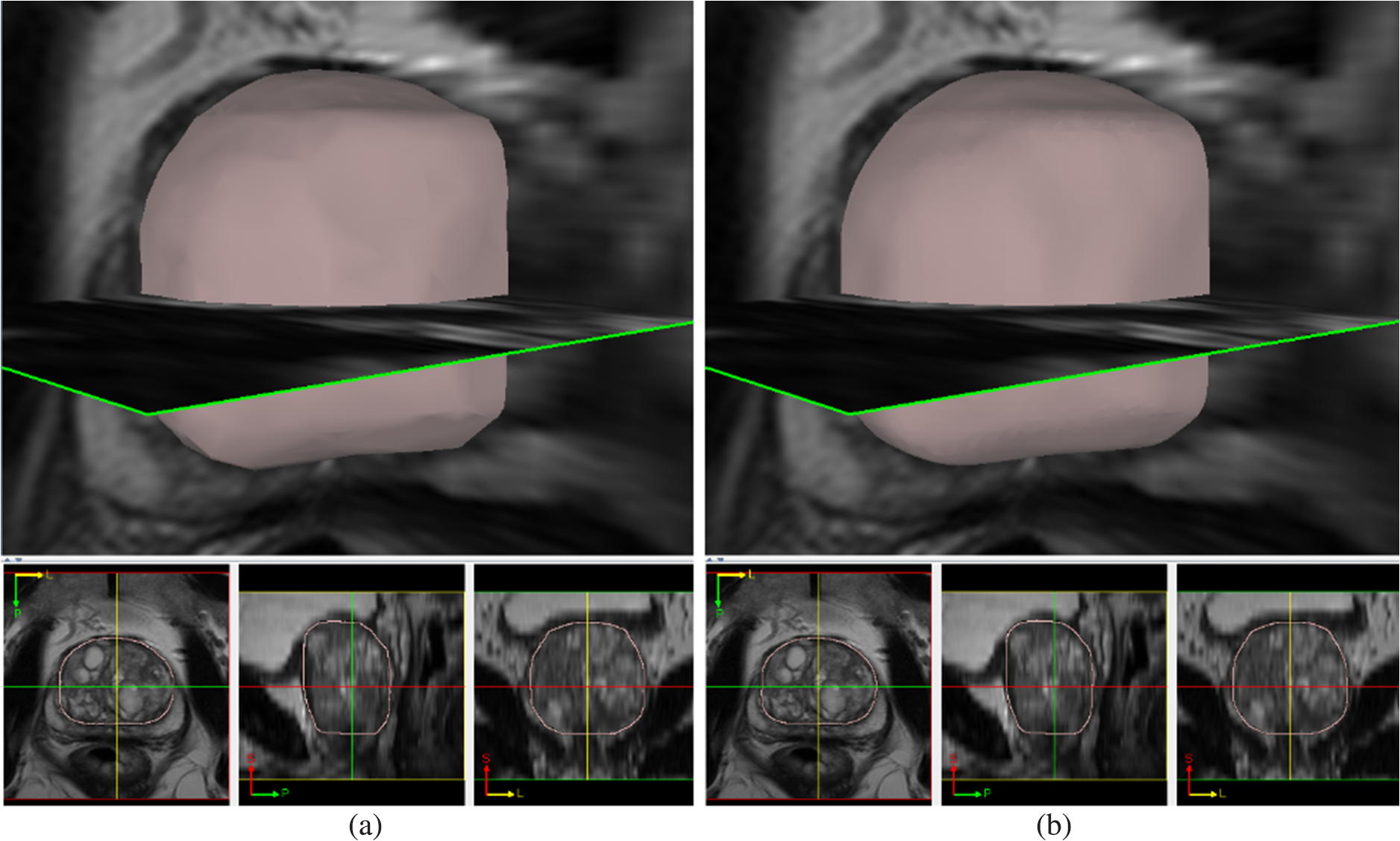 Fully Automated Prostate Whole Gland And Central Gland