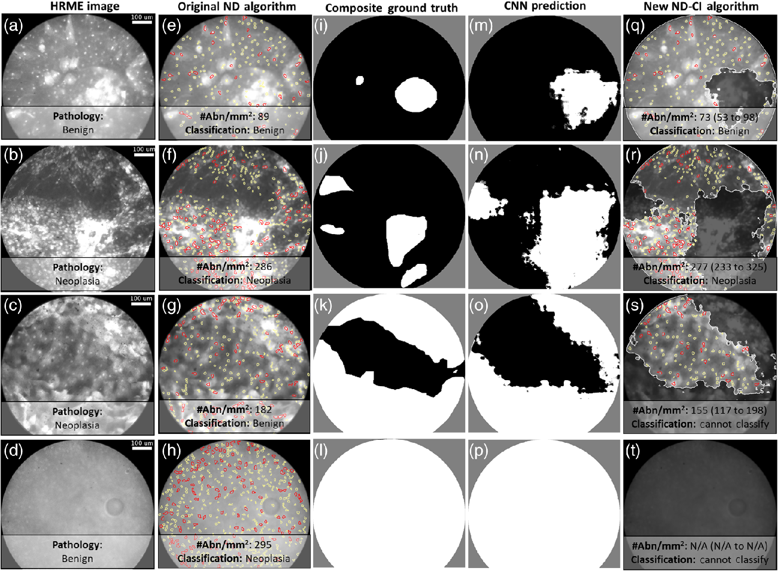 Algorithm To Quantify Nuclear Features And Confidence Intervals For Classification Of Oral Neoplasia From High Resolution Optical Images