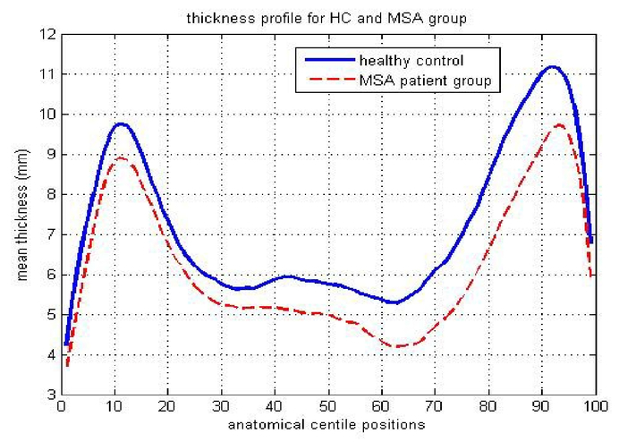 Quantitative Analysis Of Structural Variations In Corpus Callosum In Adults With Multiple System Atrophy Msa