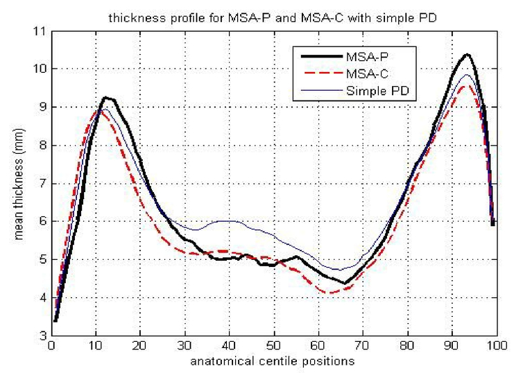Quantitative Analysis Of Structural Variations In Corpus Callosum In Adults With Multiple System Atrophy Msa
