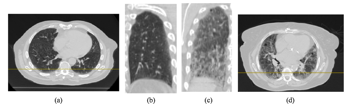 malignant mesothelioma in genes