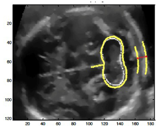 Is a fold what nuchal Nuchal Translucency