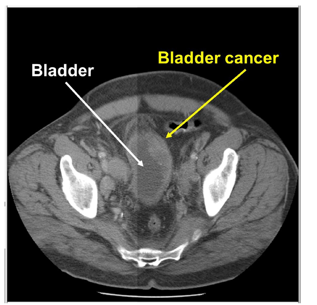 Will A Ct Scan Show Bladder Cancer ️ Updated Guide 2022
